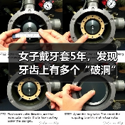 女子戴牙套5年，发现牙齿上有多个“破洞” 来源：互联网 2025-08-26（图4）