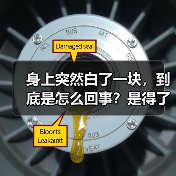 身上突然白了一块,到底是怎么回事?是得了白癜风吗? 来源:互联网 2026-04-22(图1) 身上突然白了一块,到底是怎么回事?是得了白癜风吗? 来源:互联网 2026-04-22(图1)